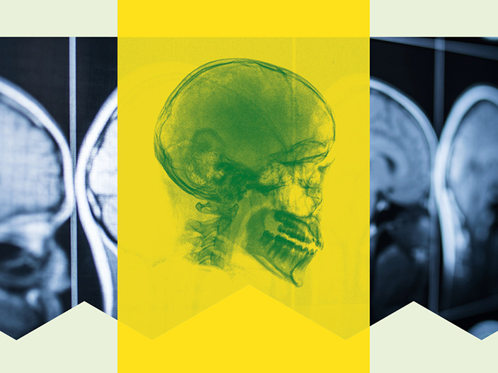 A graphic of a human skull in an x-ray